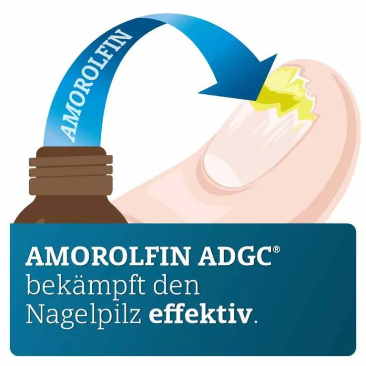 Amorolfin ADGC 50 mg / ml wirkstoffhalt.Nagellack, 3 ml