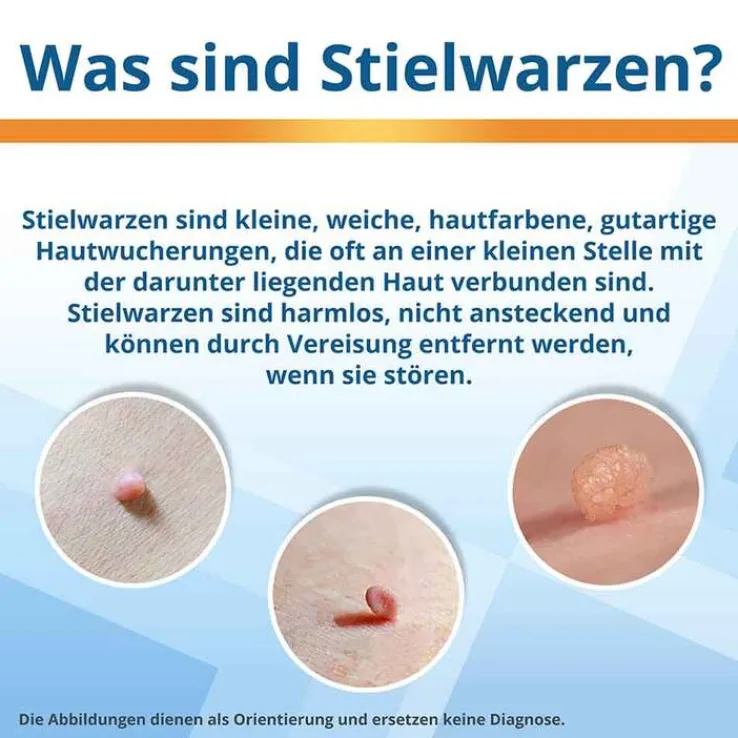 EndWarts® Extra gegen Stielwarzen, 14.3 g