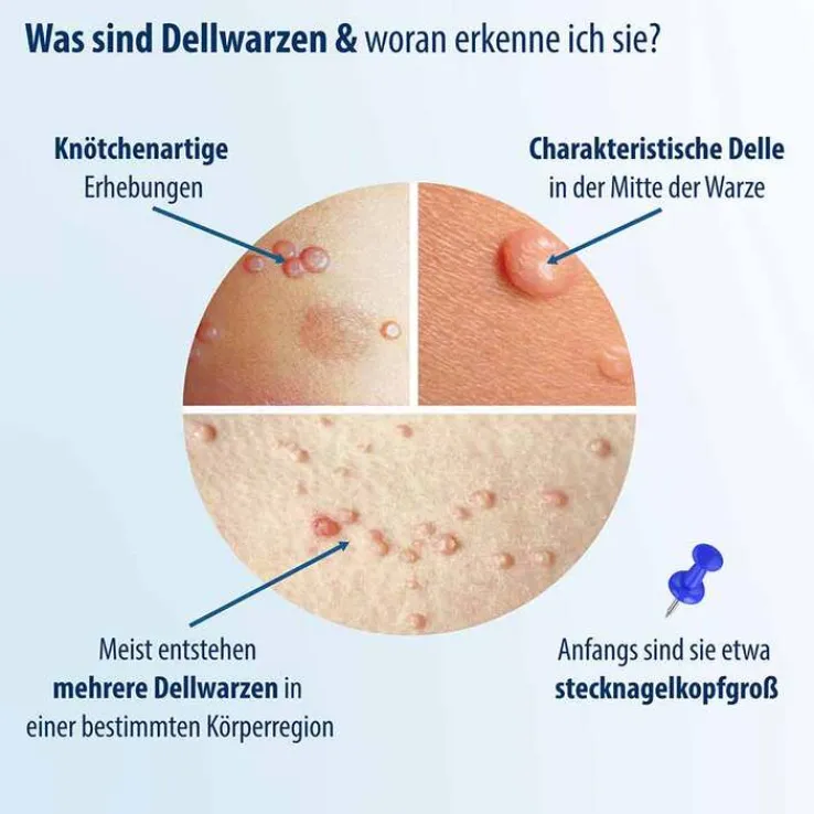 Evolsin Dellwarzen Mittel Lösung, 5 ml