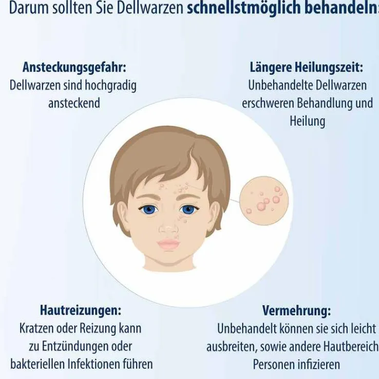 Evolsin Dellwarzen Mittel Lösung, 5 ml